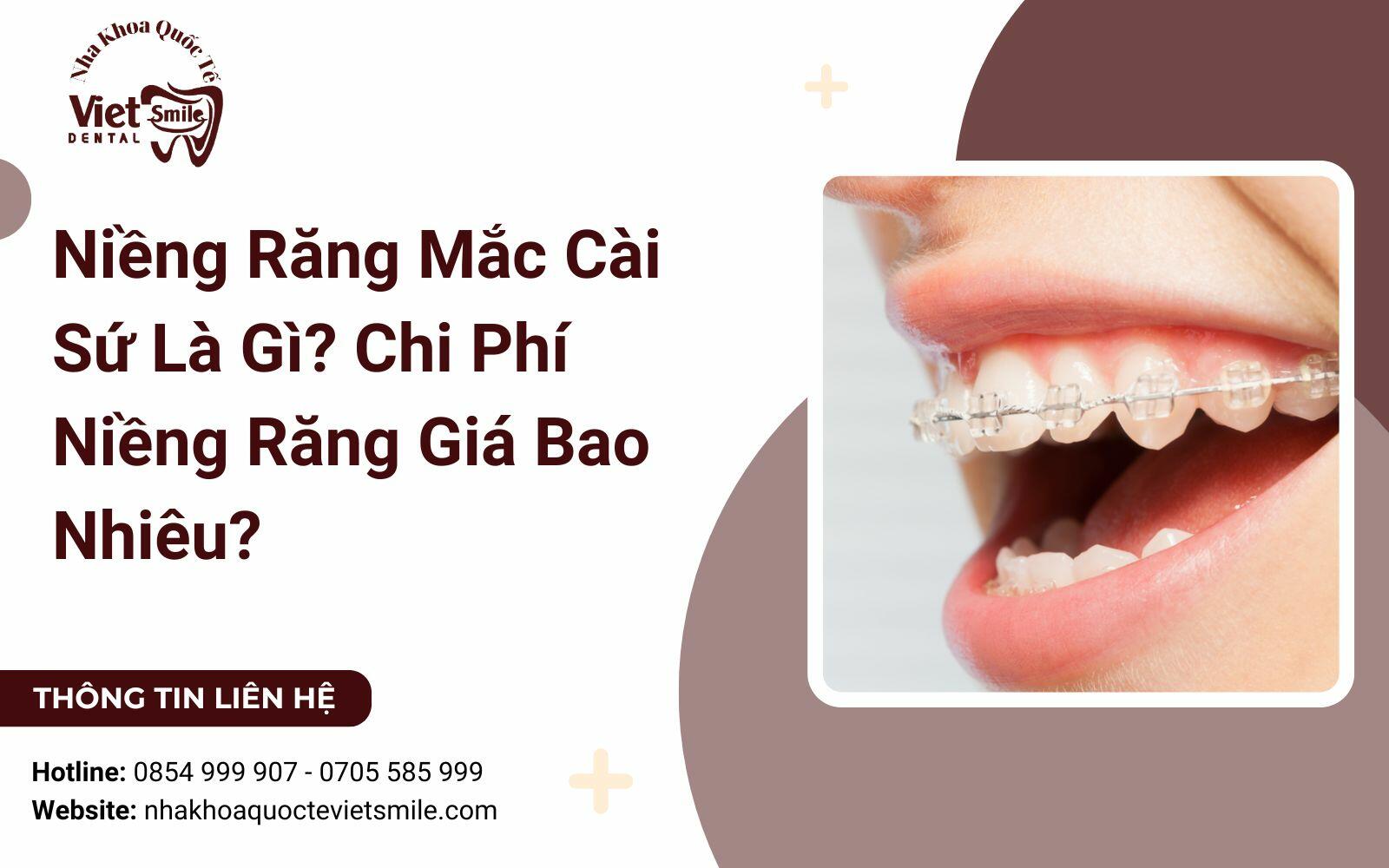 Niềng Răng Mắc Cài Sứ Là Gì? Chi Phí Niềng Răng Giá Bao Nhiêu?