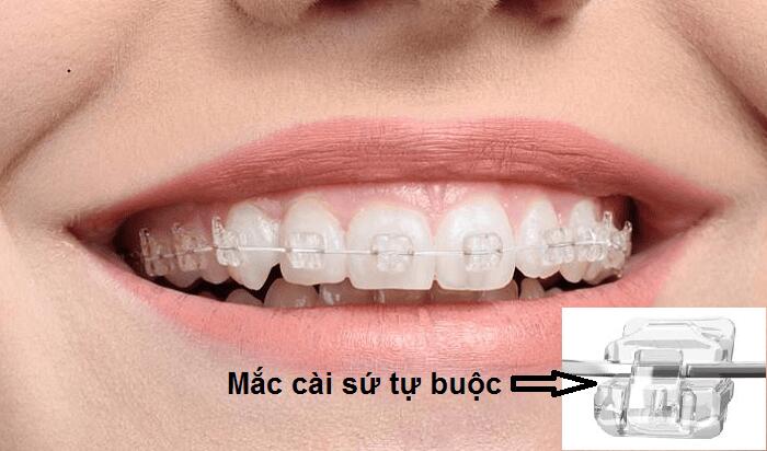 Niềng răng mắc cài sứ tự buộc