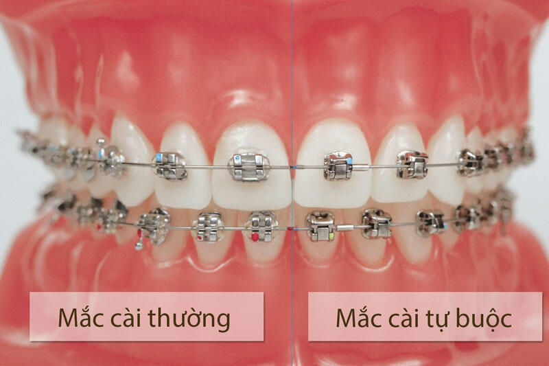 So sánh niềng răng mắc cài kim loại tự buộc và mắc cài sứ tự buộc