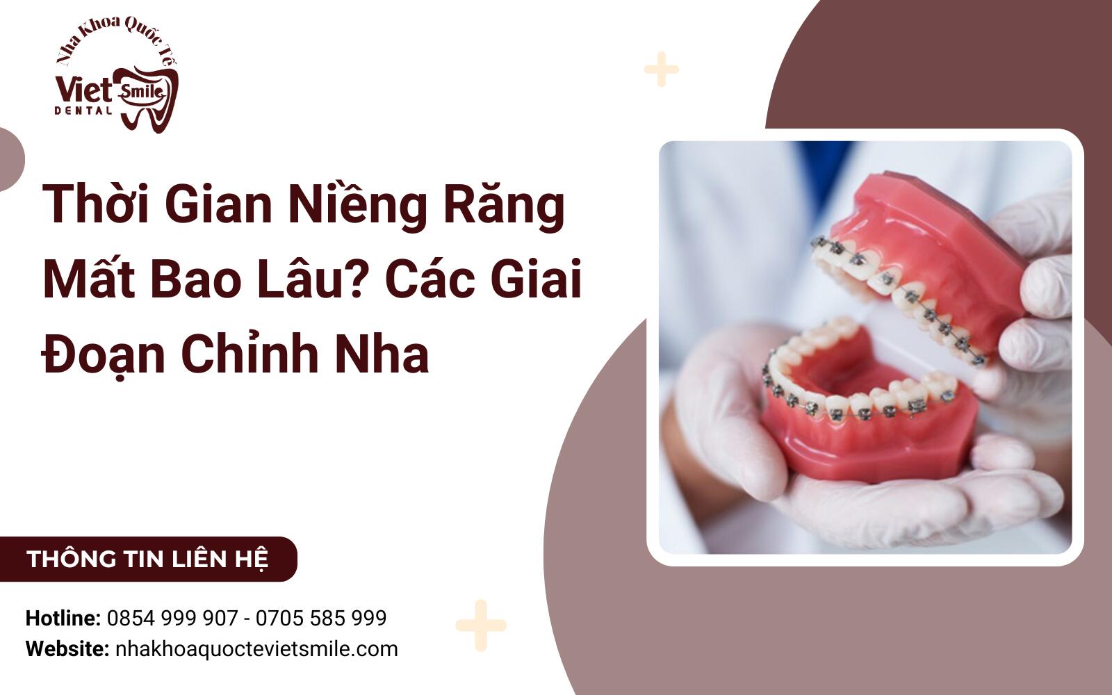 Thời Gian Niềng Răng Mất Bao Lâu? Các Giai Đoạn Chỉnh Nha