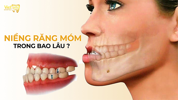 Niềng răng móm trong bao lâu và yếu tố ảnh hưởng