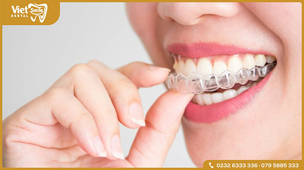 Niềng răng khay trong suốt Invisalign