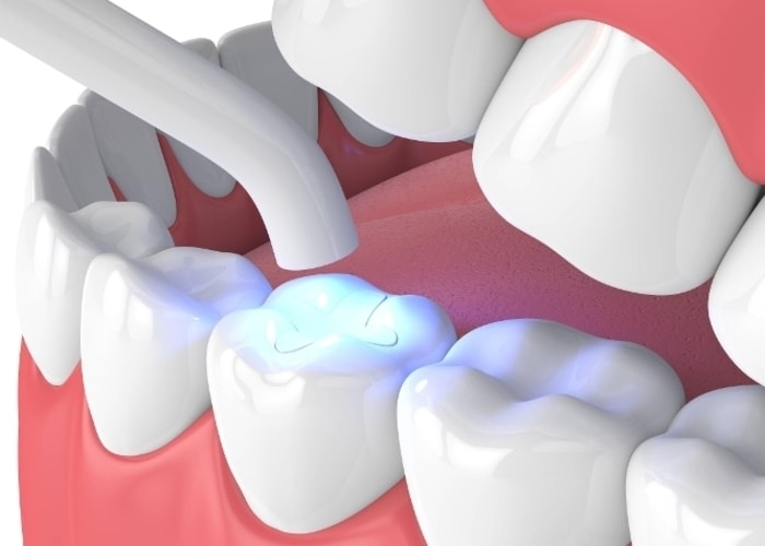 Quy trình trám răng sâu được diễn ra như thế nào?