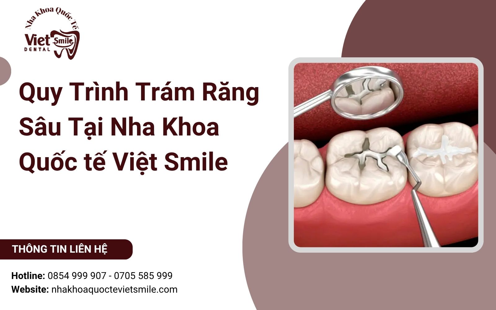 Quy Trình Trám Răng Sâu Tại Nha Khoa Quốc tế Việt Smile