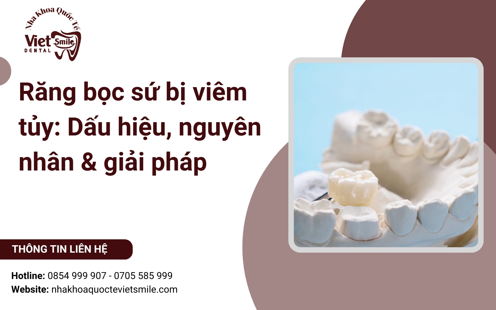 Răng bọc sứ bị viêm tủy: Dấu hiệu, nguyên nhân & giải pháp