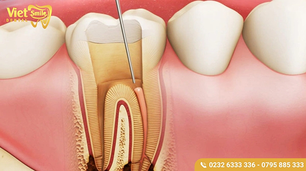 Răng đã lấy tủy có niềng được không?