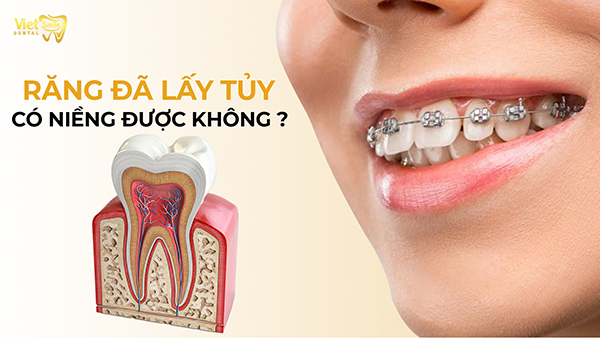 Răng đã lấy tủy có niềng được không? Trường hợp không nên niềng răng