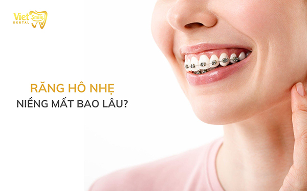 Răng hô nhẹ niềng mất bao lâu mới đều và đẹp?