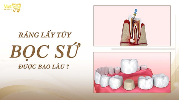 Răng lấy tủy bọc sứ được bao lâu? Răng lấy tủy tồn tại được bao lâu? 