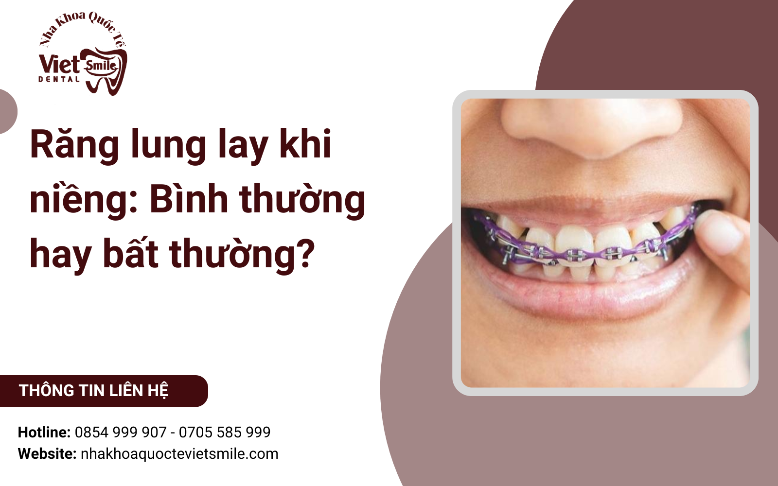 Răng lung lay khi niềng: Bình thường hay bất thường?