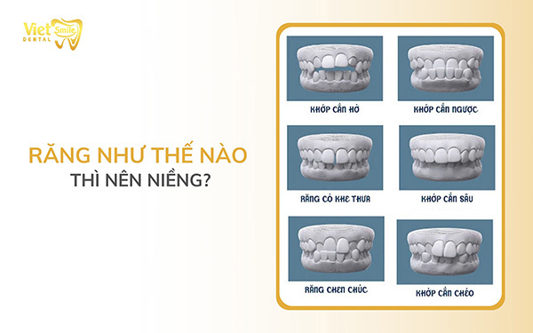 Răng như thế nào thì nên niềng?