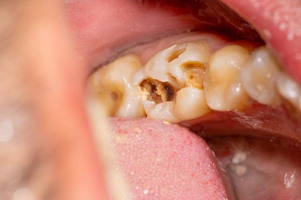 Răng bị mẻ vỡ lớn nhưng chưa ảnh hưởng đến tủy