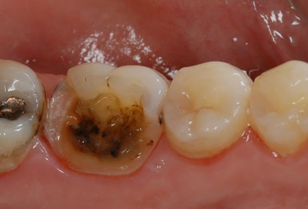 Răng bị vỡ mẻ đã ảnh hưởng đến tủy