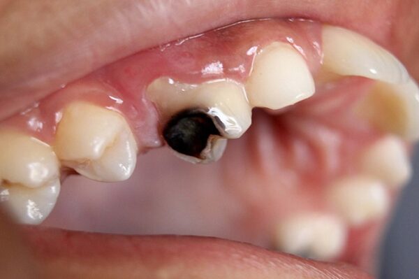 Răng bị bể lớn không thể điều trị được nữa
