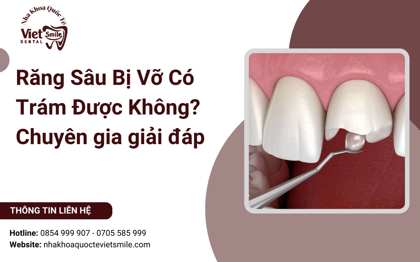 Răng Sâu Bị Vỡ Có Trám Được Không? Chuyên Gia Giải Đáp
