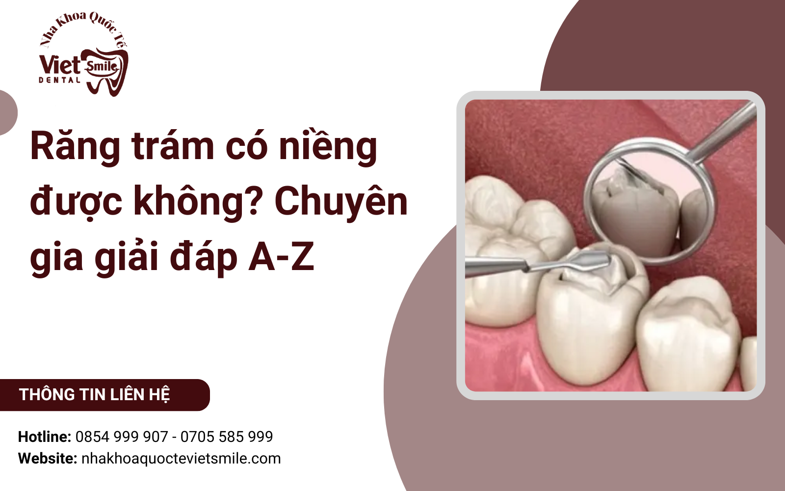 Răng trám có niềng được không? Chuyên gia giải đáp A-Z