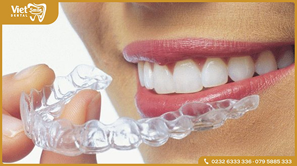 Niềng răng không mắc cài Invisalign