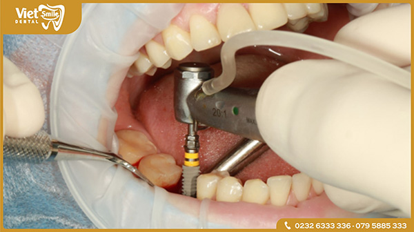 Cấy Implant tức thì sau nhổ răng