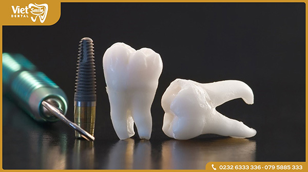 Cấy ghép Implant tức thì như thế nào?