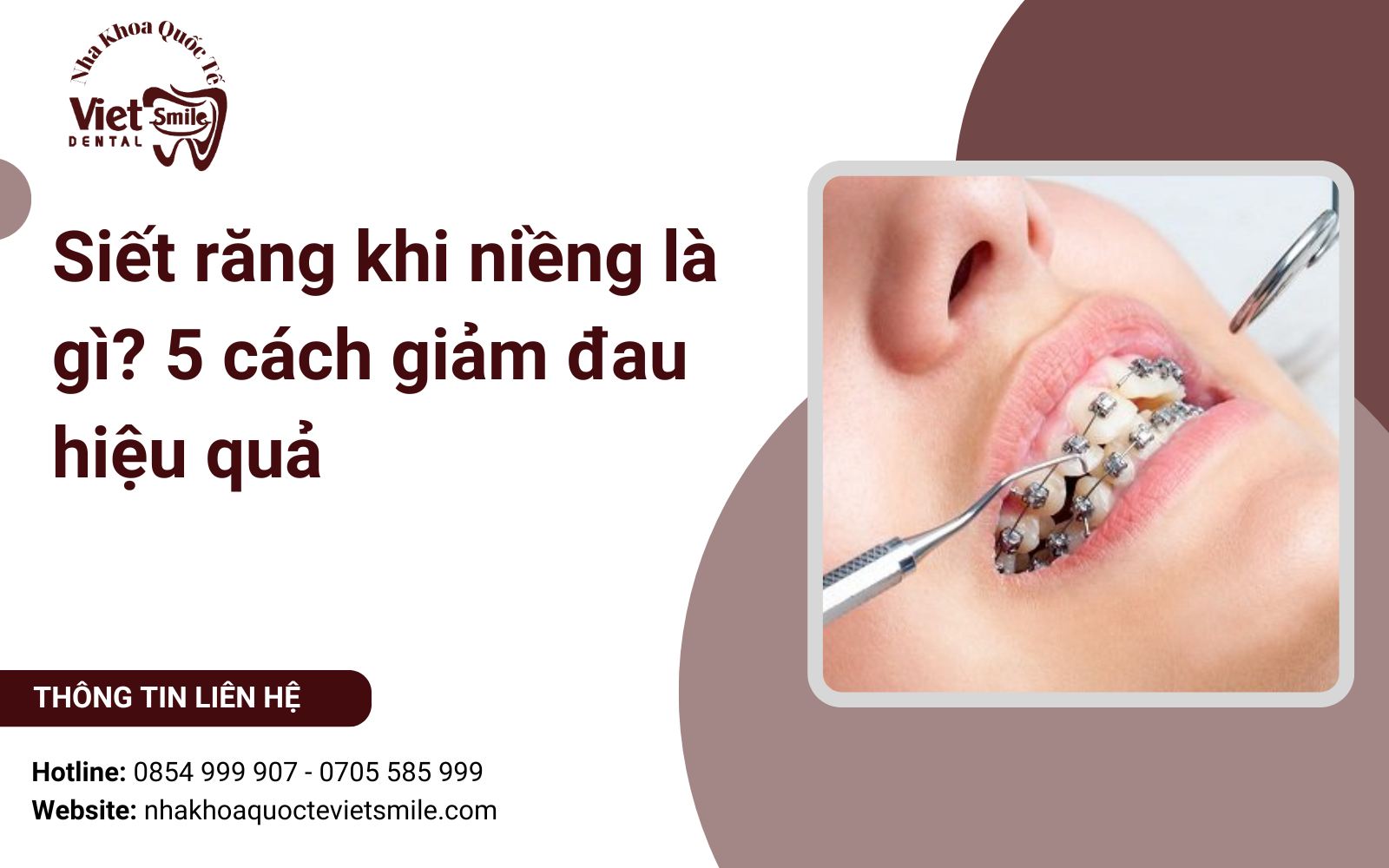 Siết răng khi niềng là gì? 5 cách giảm đau hiệu quả