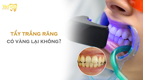 Tẩy trắng răng có bị vàng lại không? Nguyên nhân và cách khắc phục