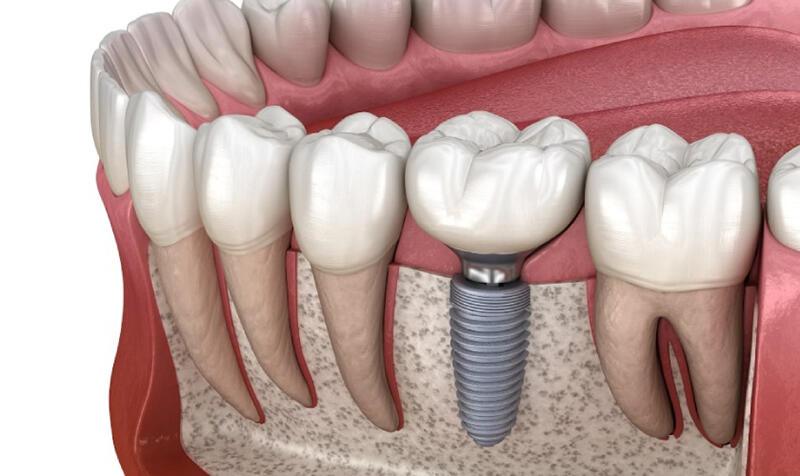 Trồng răng implant là gì?