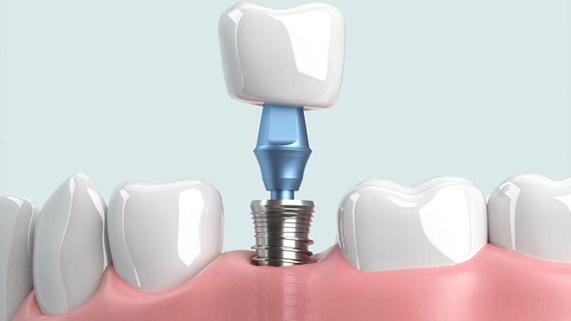 Quy trình trồng implant tại Nha khoa Quốc tế Việt Smile - Quảng Bình