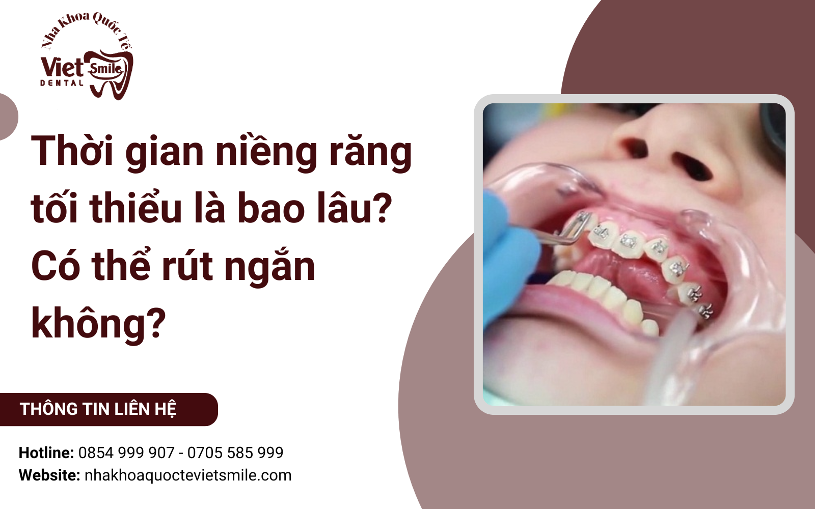 Thời gian niềng răng tối thiểu là bao lâu? Có thể rút ngắn không?