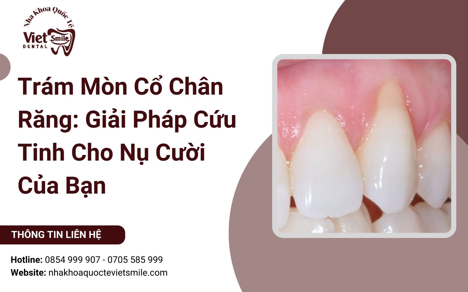 Trám Mòn Cổ Chân Răng: Giải Pháp Cứu Tinh Cho Nụ Cười Của Bạn