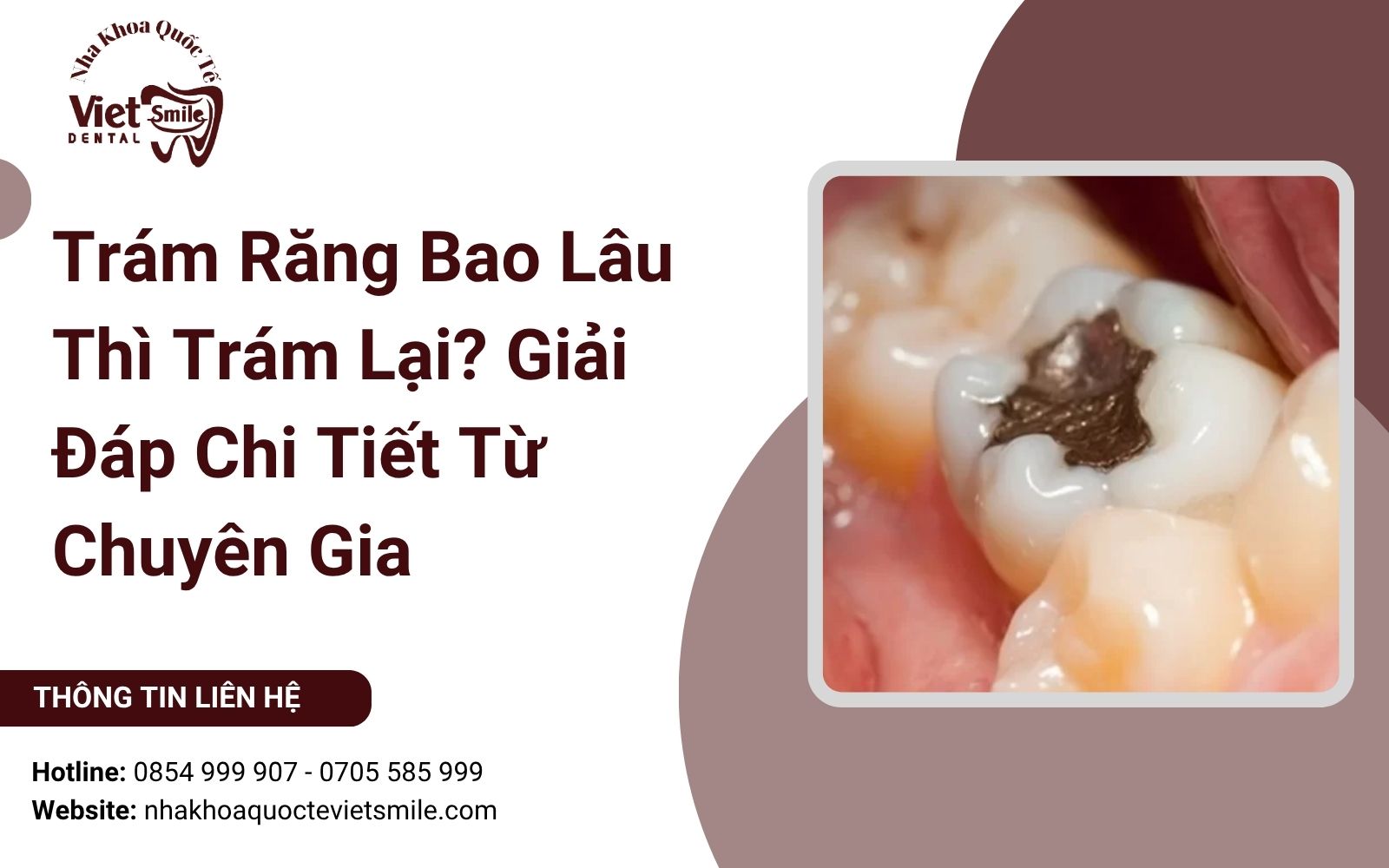 Trám Răng Bao Lâu Thì Trám Lại? Giải Đáp Chi Tiết Từ Chuyên Gia
