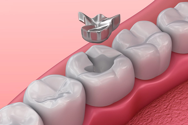 Chất liệu trám amalgam