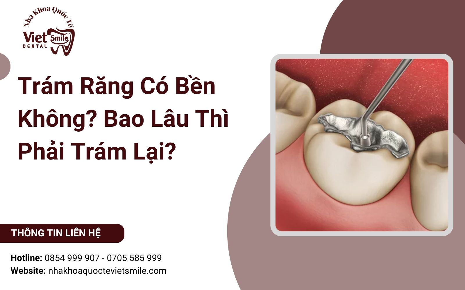 Trám Răng Có Bền Không? Bao Lâu Thì Phải Trám Lại?