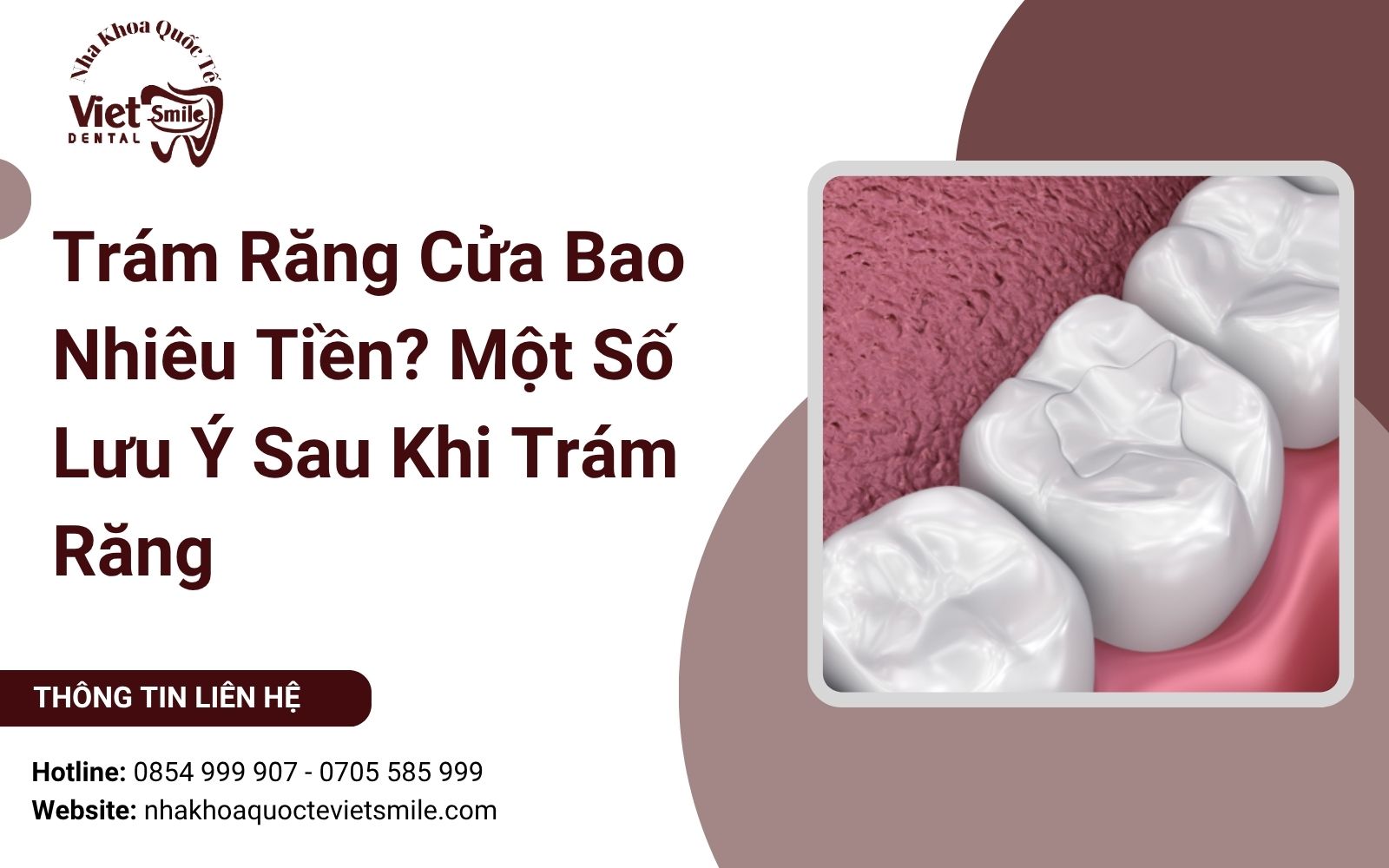 Trám Răng Cửa Bao Nhiêu Tiền? Một Số Lưu Ý Sau Khi Trám Răng