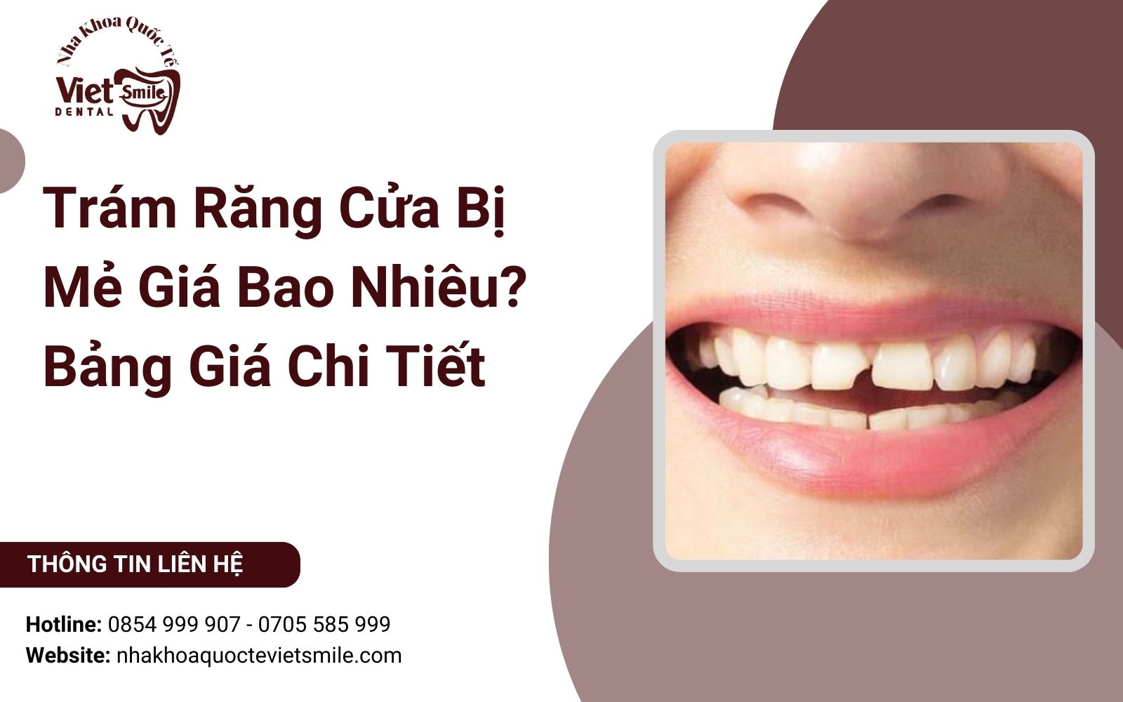 Trám Răng Cửa Bị Mẻ Giá Bao Nhiêu? Bảng Giá Chi Tiết 2025