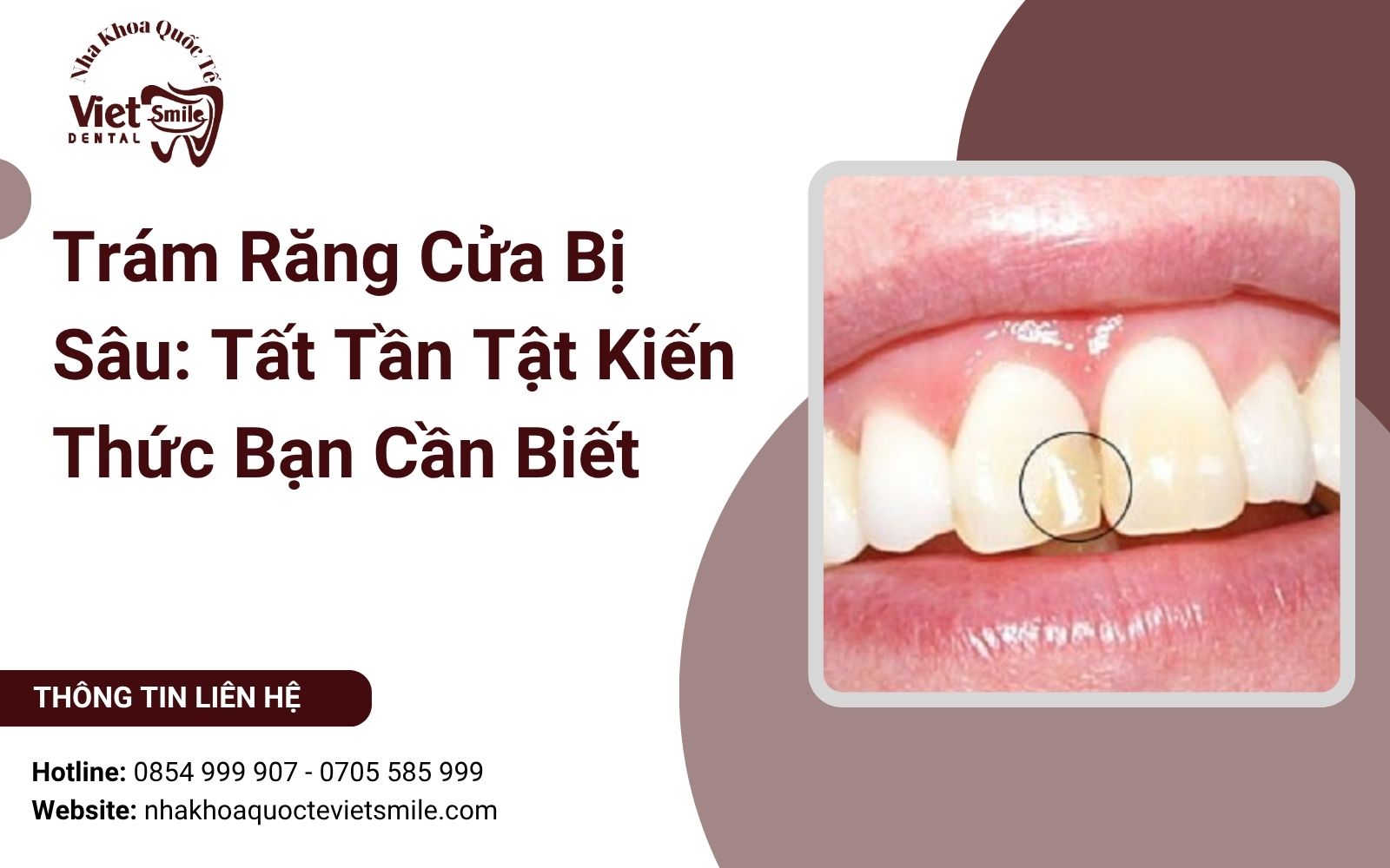 Trám Răng Cửa Bị Sâu: Tất Tần Tật Kiến Thức Bạn Cần Biết