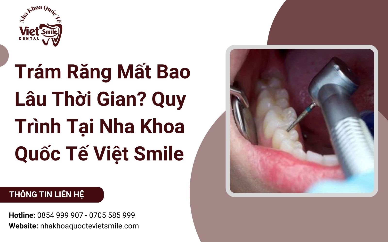Trám Răng Mất Bao Lâu Thời Gian? Quy Trình Tại Nha Khoa Quốc Tế Việt Smile