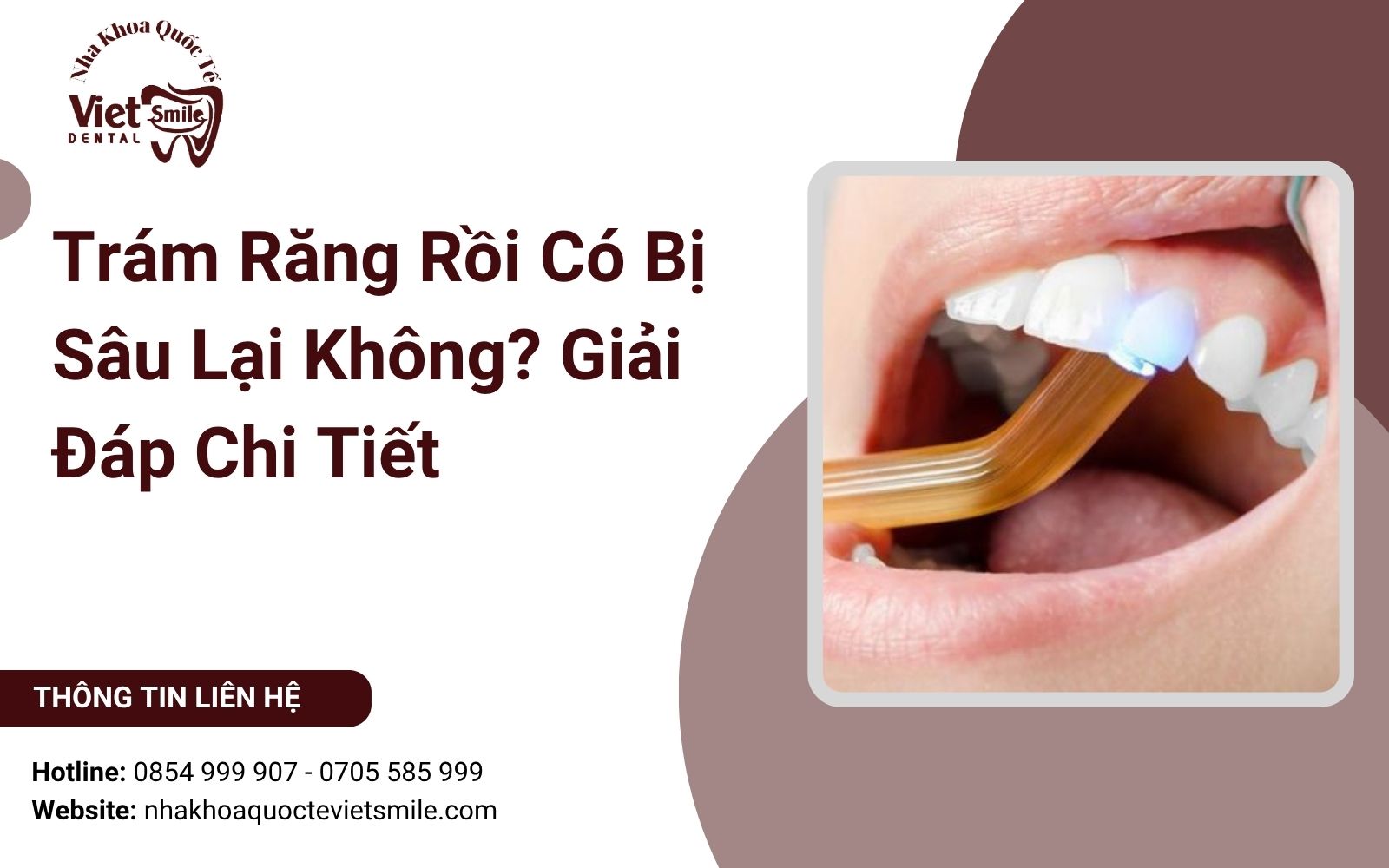 Trám Răng Rồi Có Bị Sâu Lại Không? Giải Đáp Chi Tiết