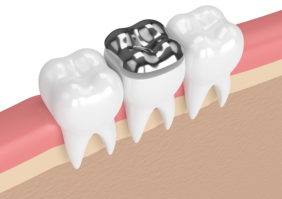 Vật liệu trám răng Amalgam