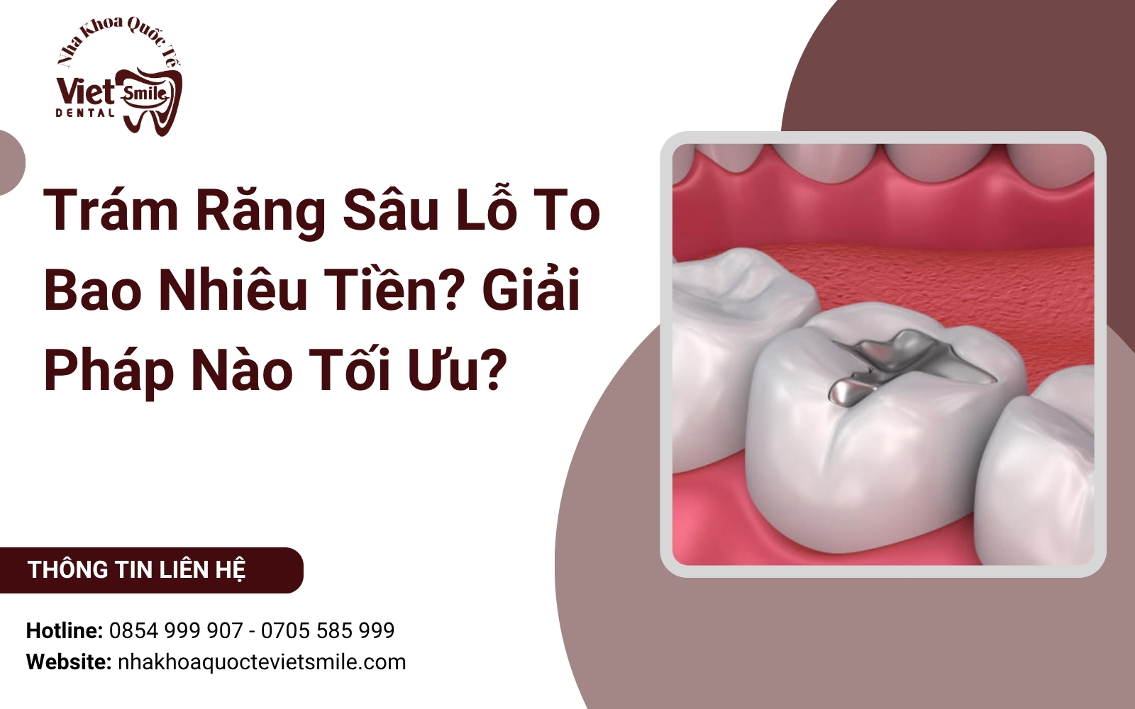 Trám Răng Sâu Lỗ To Bao Nhiêu Tiền? Giải Pháp Nào Tối Ưu?