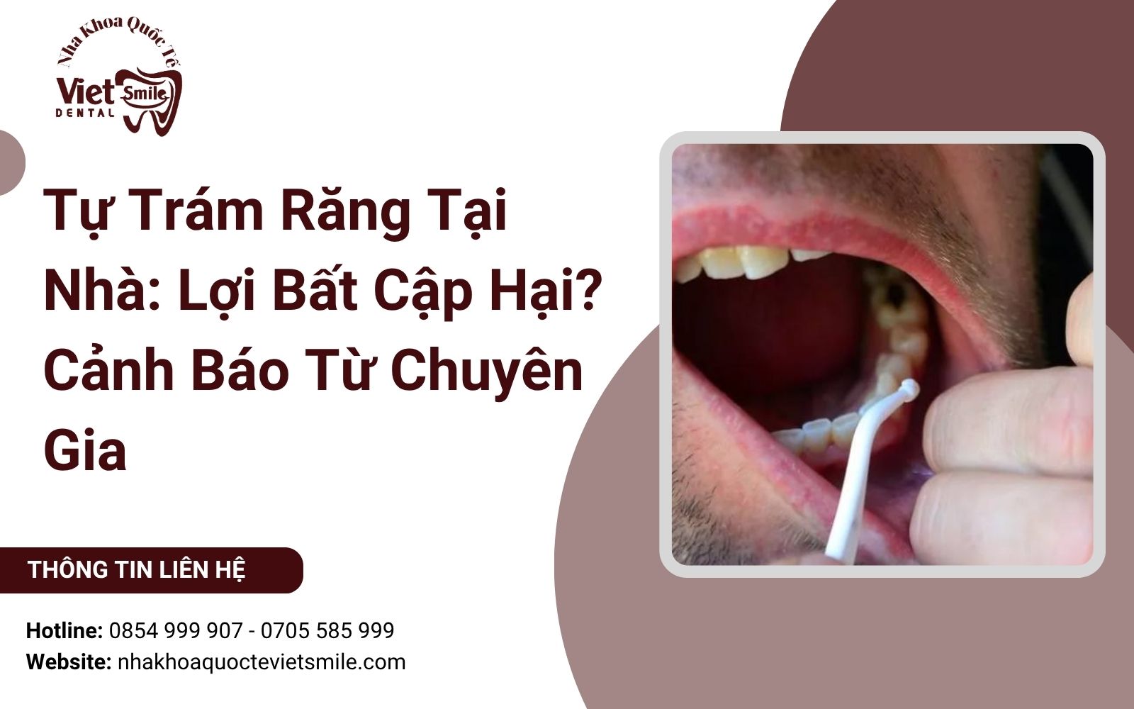 Tự Trám Răng Tại Nhà: Lợi Bất Cập Hại? Cảnh Báo Từ Chuyên Gia