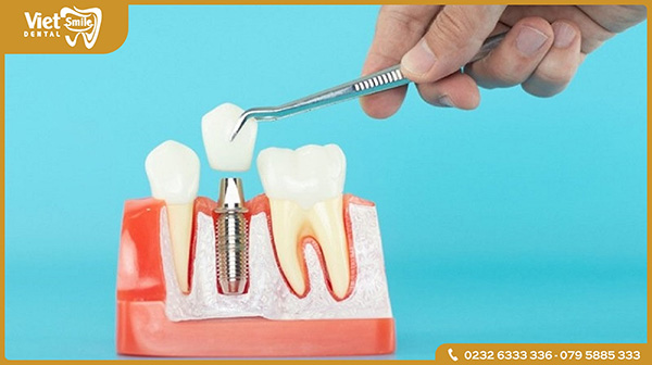 Trồng răng Implant là gì?