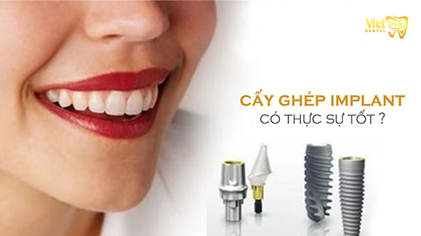 Trồng răng bằng cấy ghép Implant có thật sự tốt không? 5 ưu điểm vượt trội của trồng răng Implant