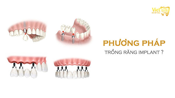 Trồng răng cấy ghép Implant là gì? Những điều bạn nên biết