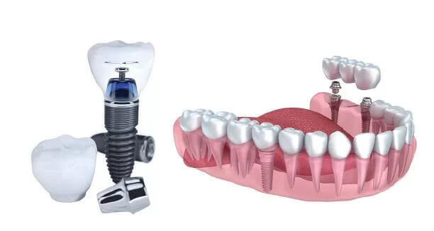 Thực hiện trồng răng Implant có đau không?