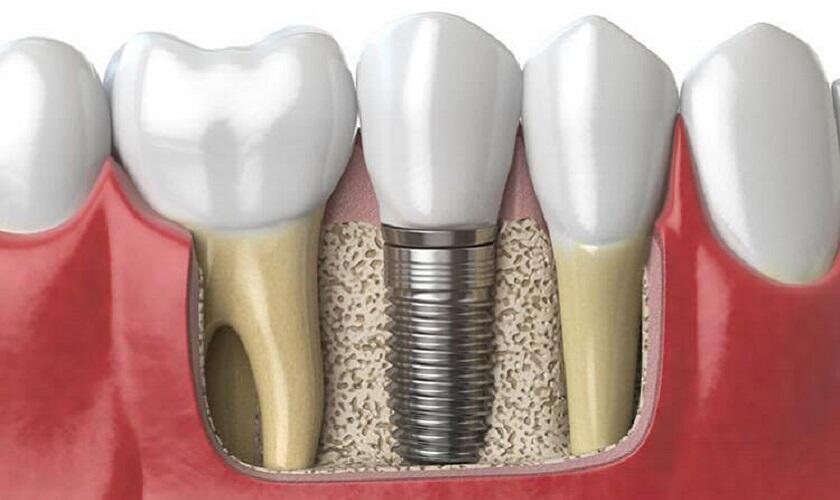 Những câu hỏi thường gặp liên quan đến trồng răng Implant