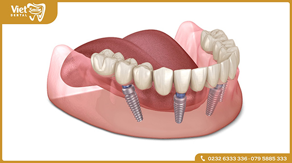 Những ưu điểm của phương pháp trồng răng Implant All on 4