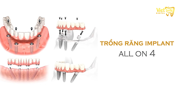 Trồng răng Implant All on 4 là gì? Phương pháp này có ưu điểm và nhược điểm gì?