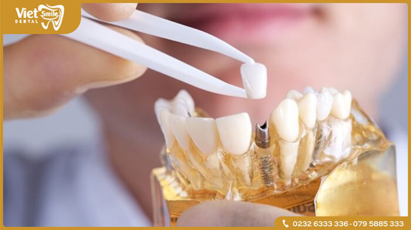 Lợi ích khi trồng răng implant có thể bạn chưa biết