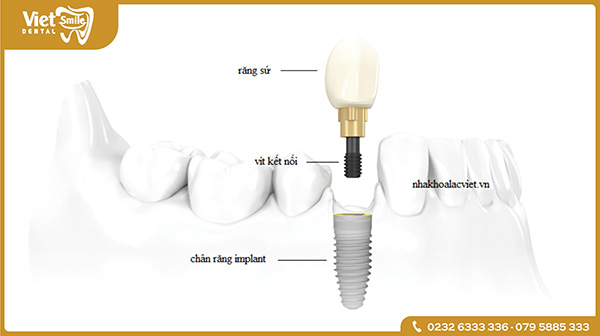 Nguyên nhân khiến bệnh nhân trồng răng implant bị lung lay là do đâu?