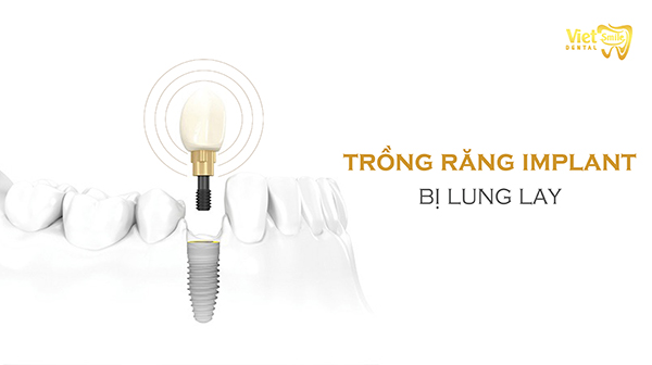 Trồng răng implant bị lung lay thì phải làm sao?